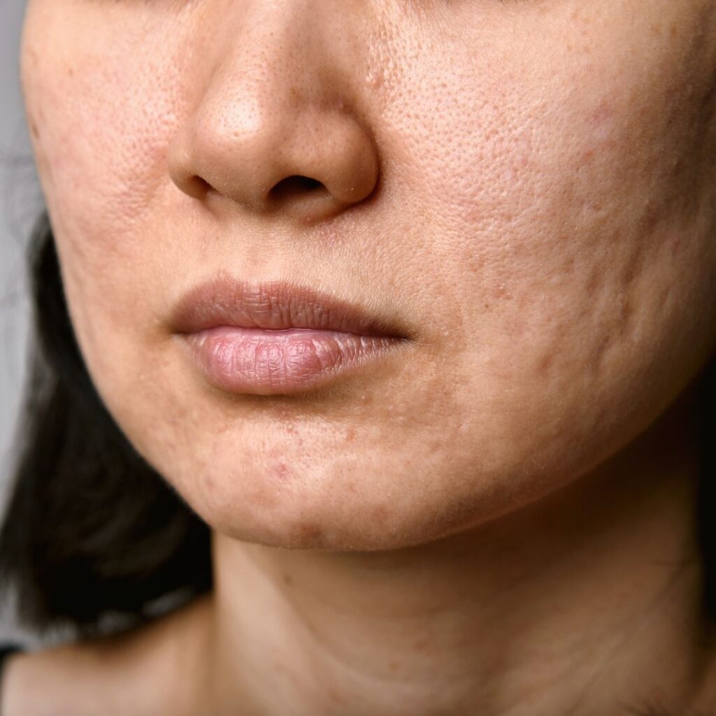 acne scars closeup woman