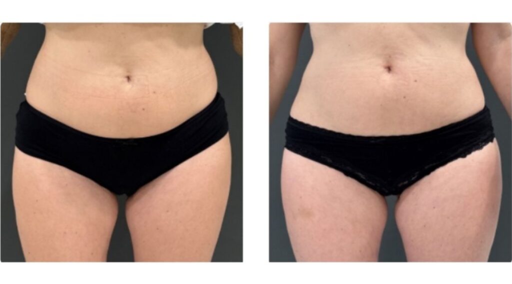 before and after musle sculpting