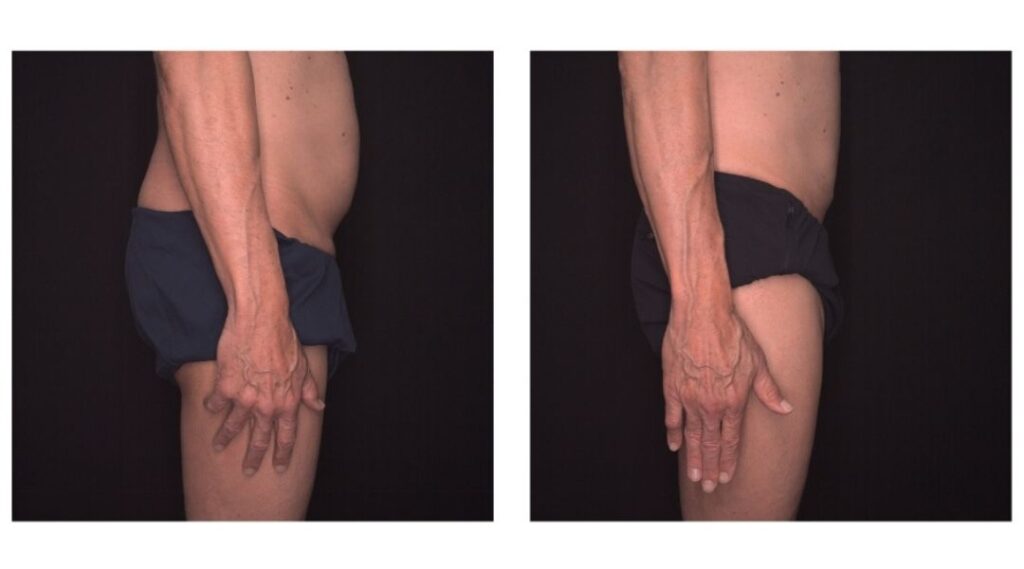 before and after musle sculpting