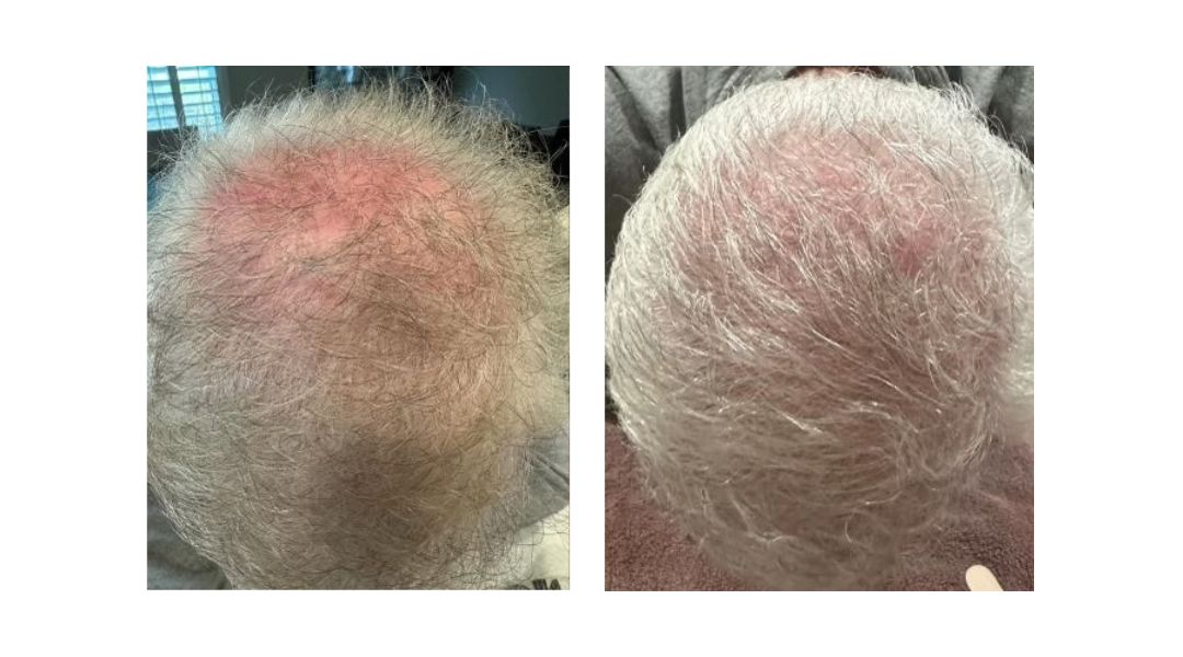 KeraFactor Serum before and after results in San Diego