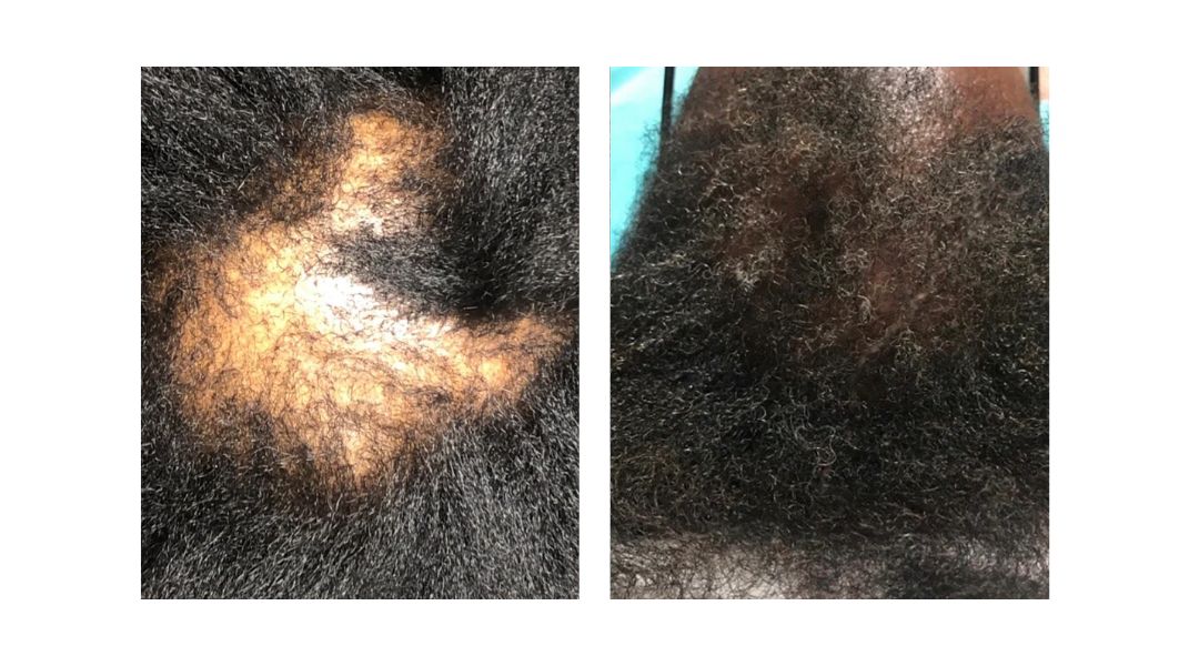 KeraFactor Serum before and after results San Diego