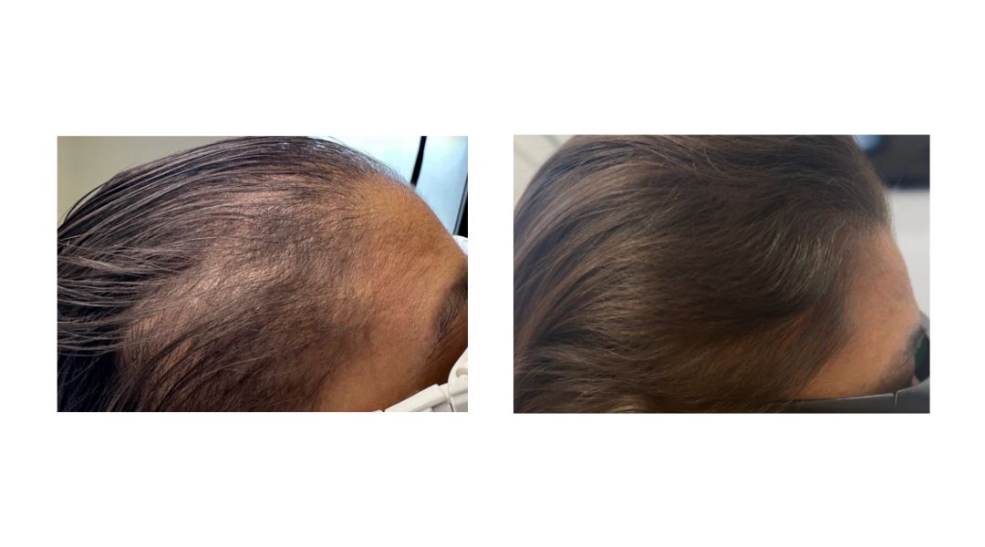 KeraFactor Serum before and after results