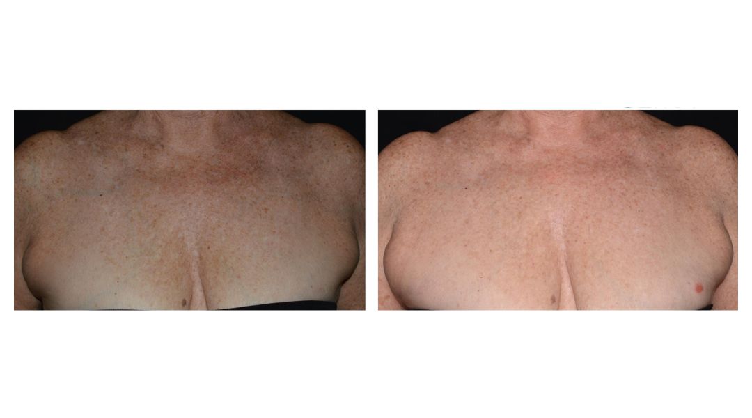 LaseMD Ultra before and after