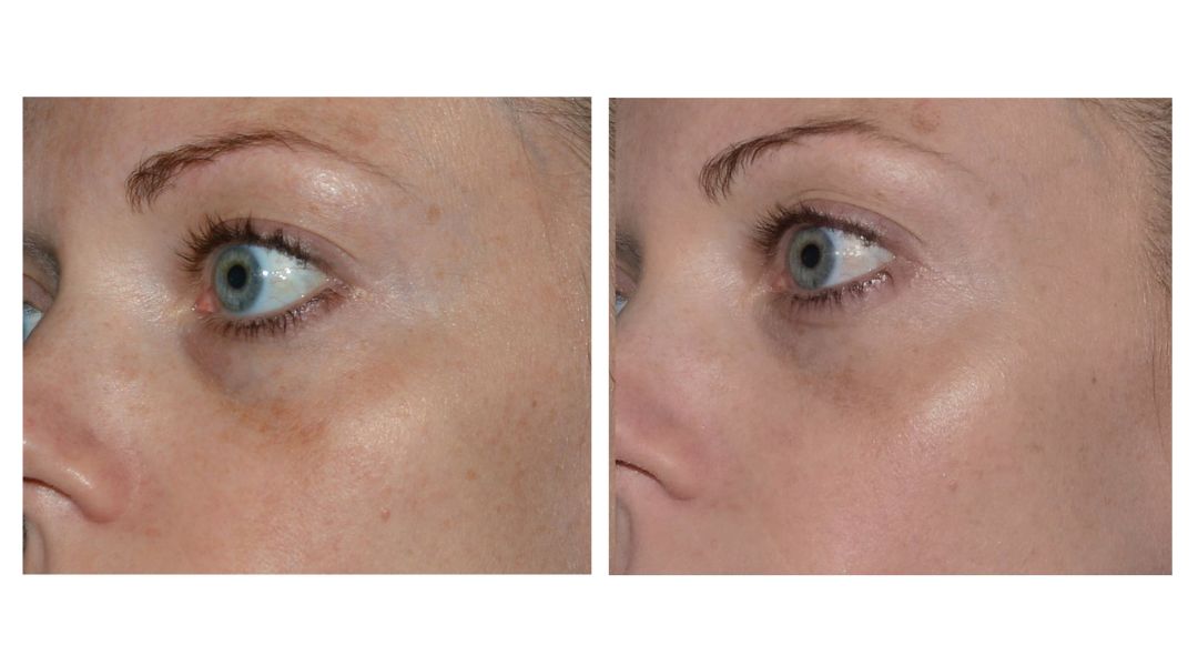 Skin rejuvenation treatment in San Diego