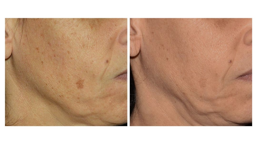 LaseMD Ultra results