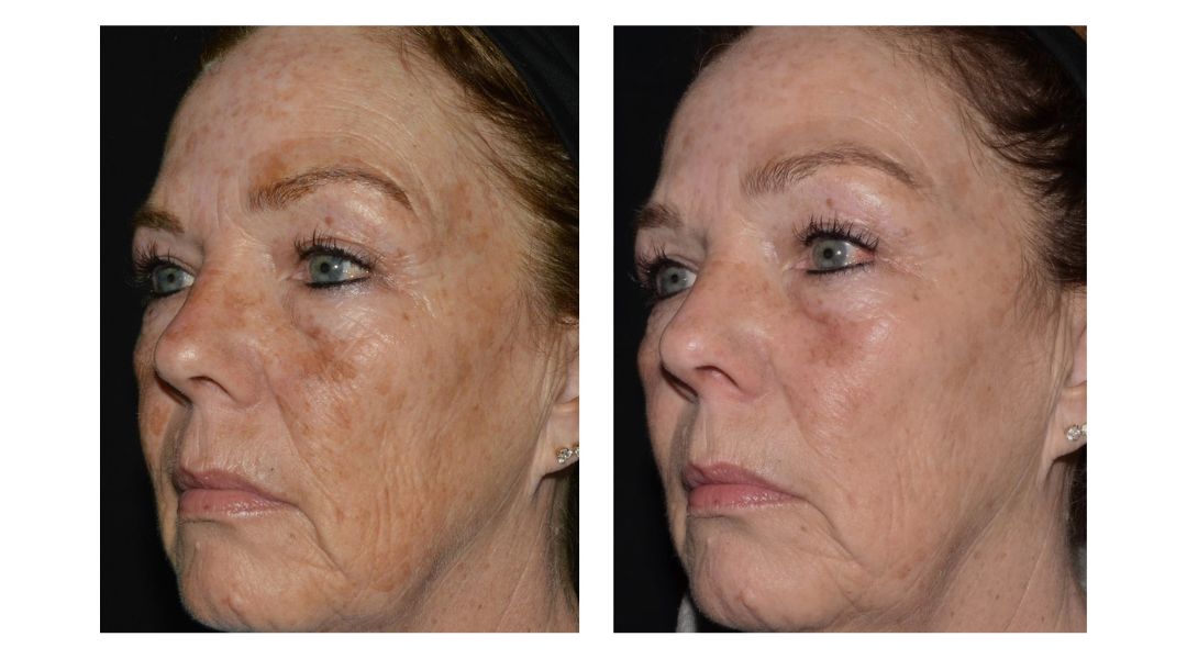 real results with LaseMD Ultra