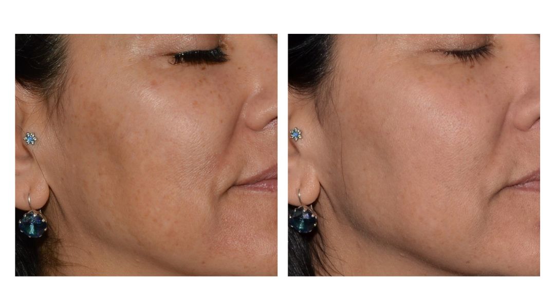 LaseMD laser treatment San Diego