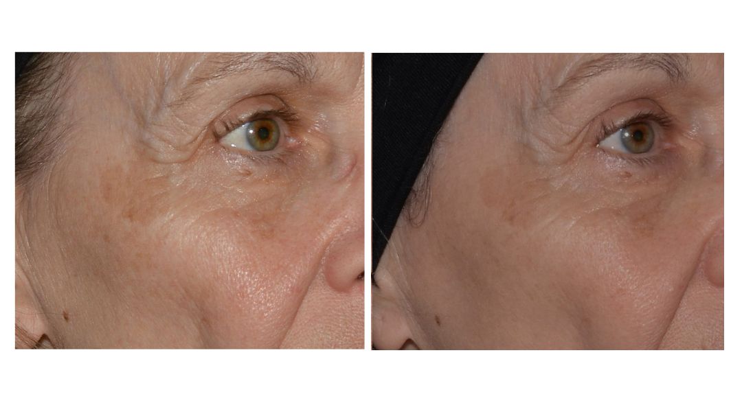 LaseMD laser treatment in San Diego