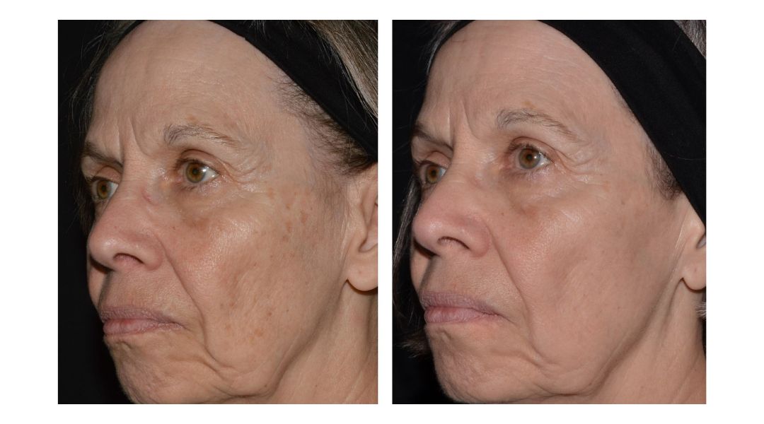 melasma treatment in san diego
