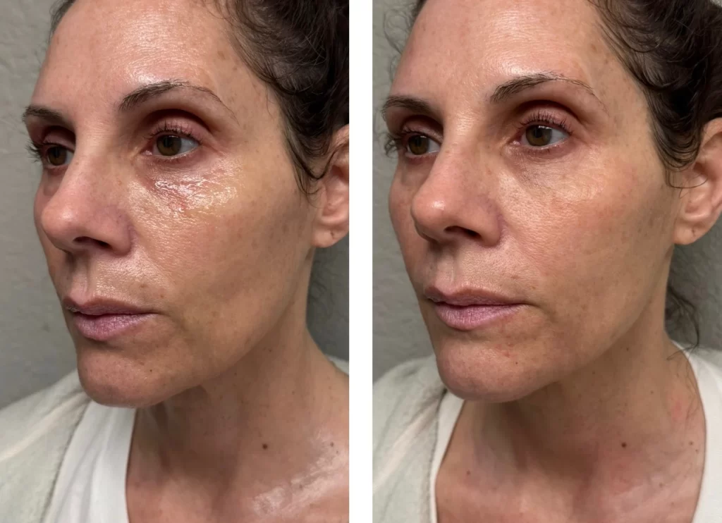 radiant lab before and after