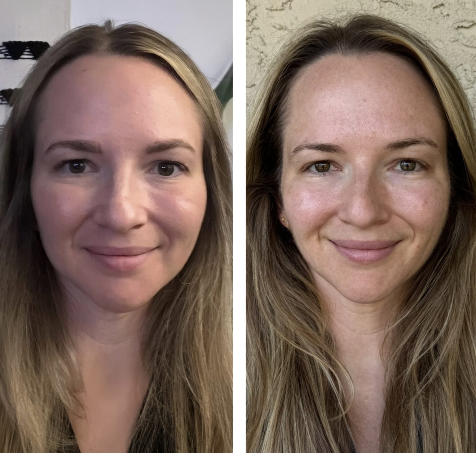 hair restoration before and after for female patient