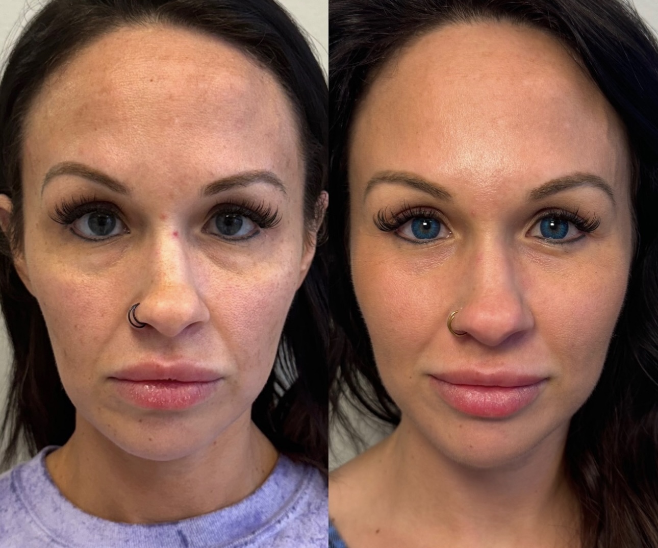 lase md before and after1