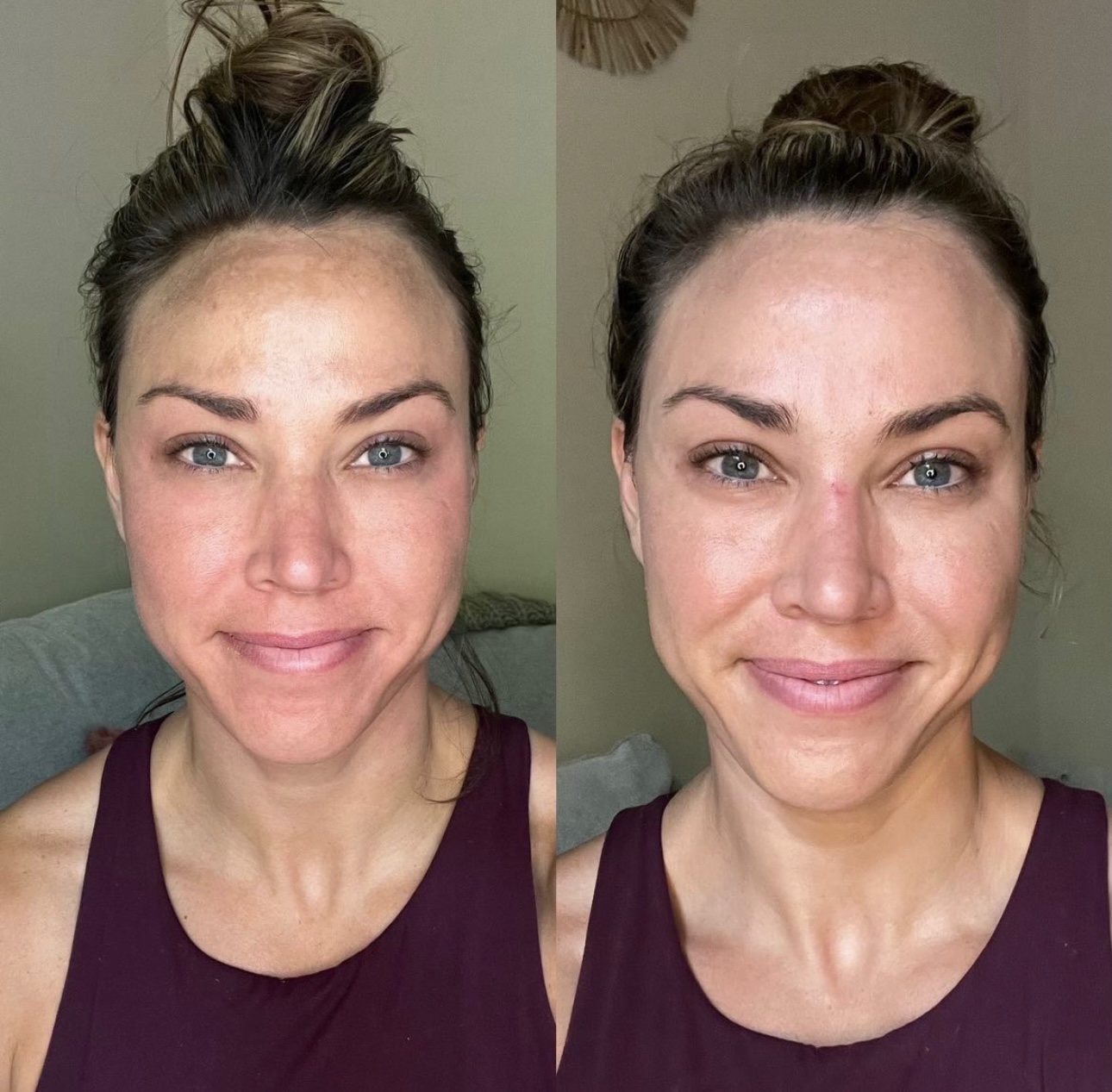 lase md before and after2