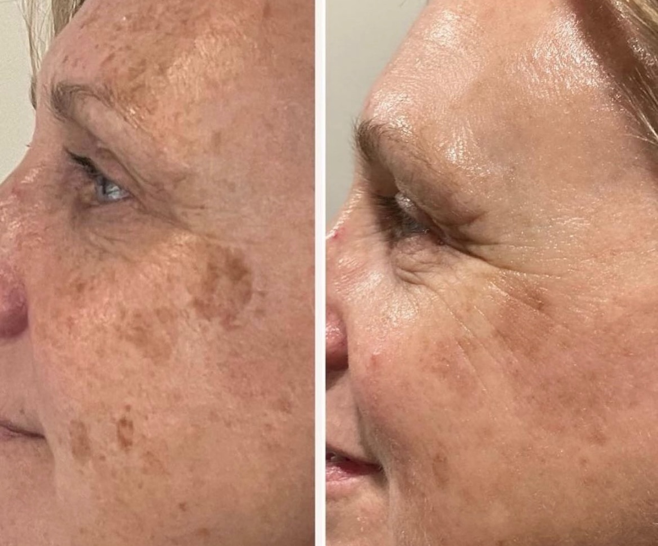 lase md before and after3