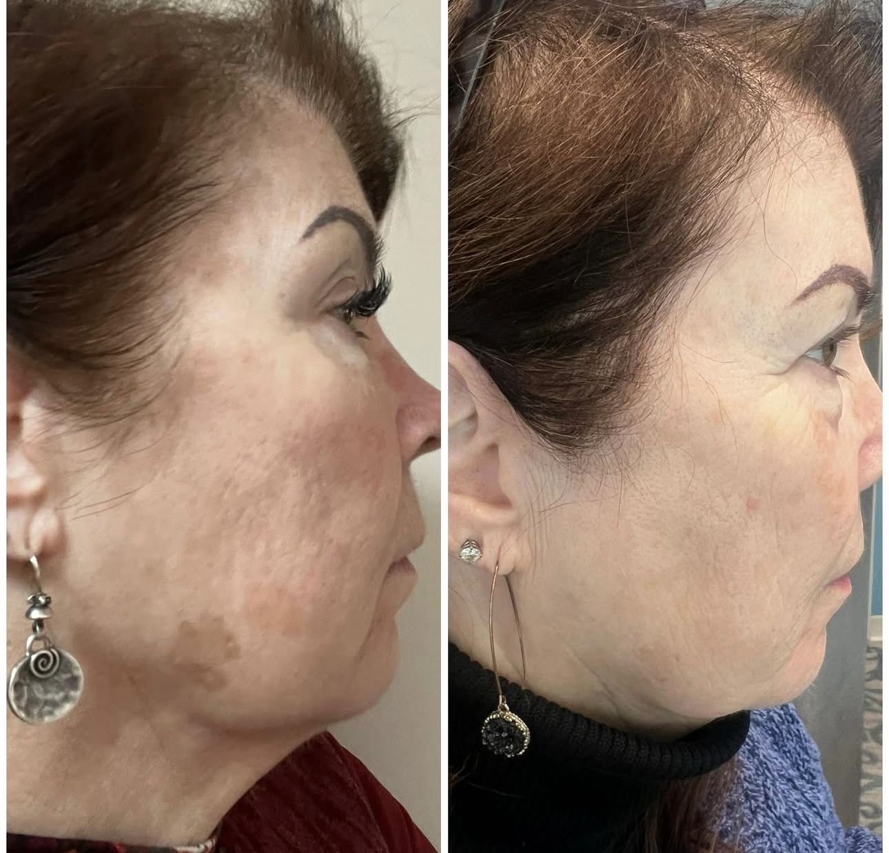 lase md before and after4