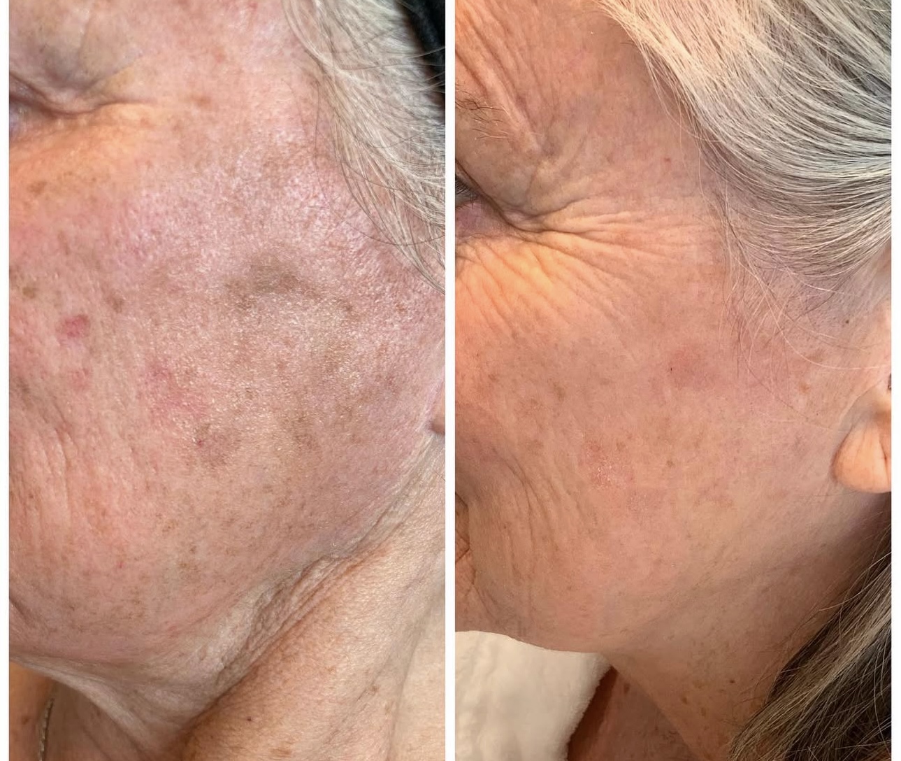 lase md before and after5