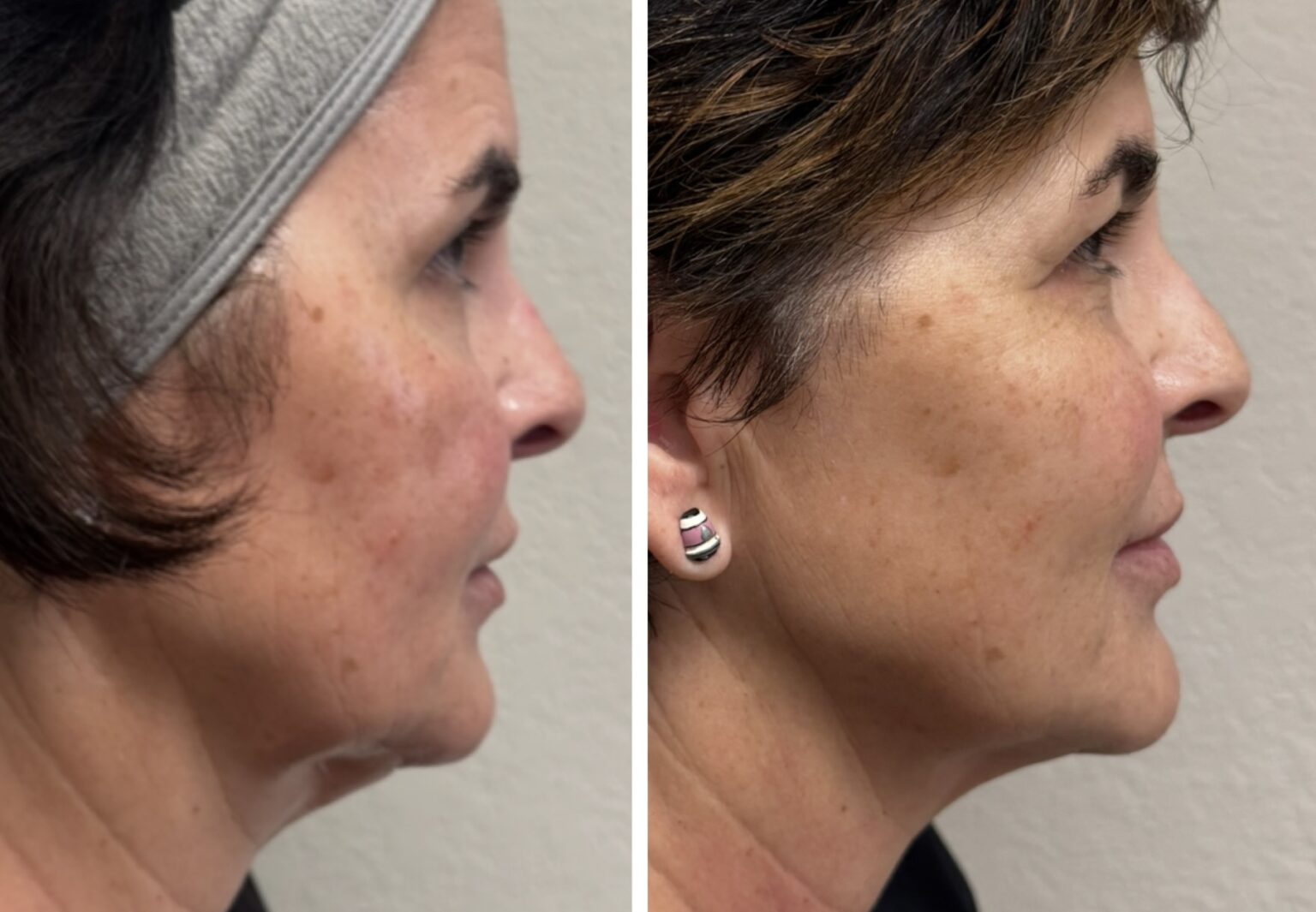 sofwave before and after results1