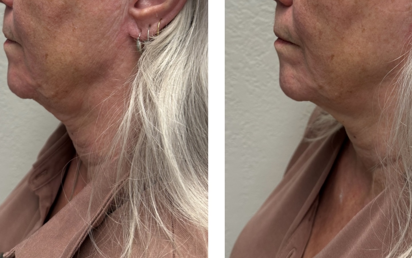 sofwave before and after results10