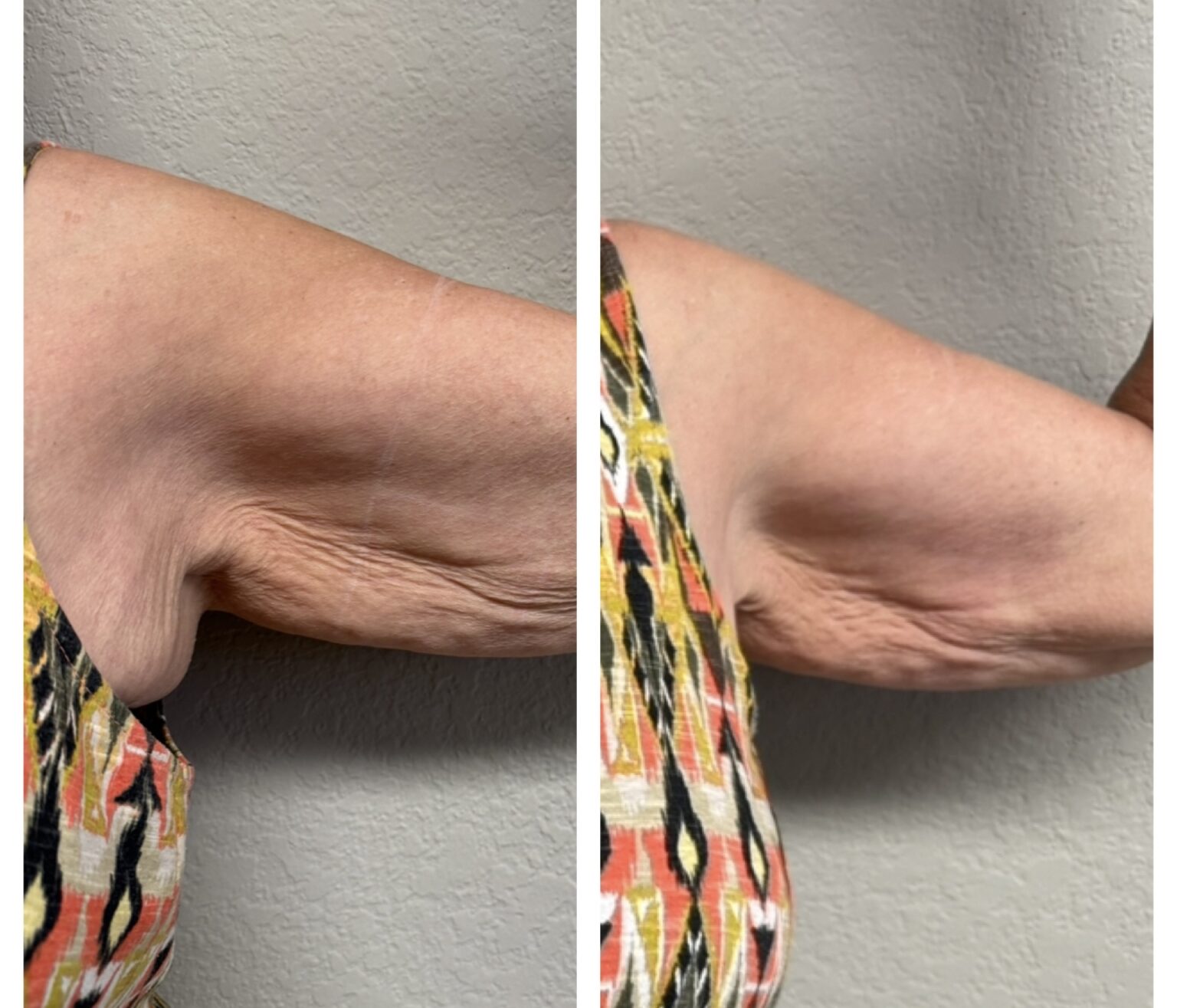 sofwave before and after results11