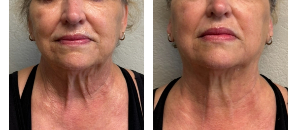 sofwave before and after results12