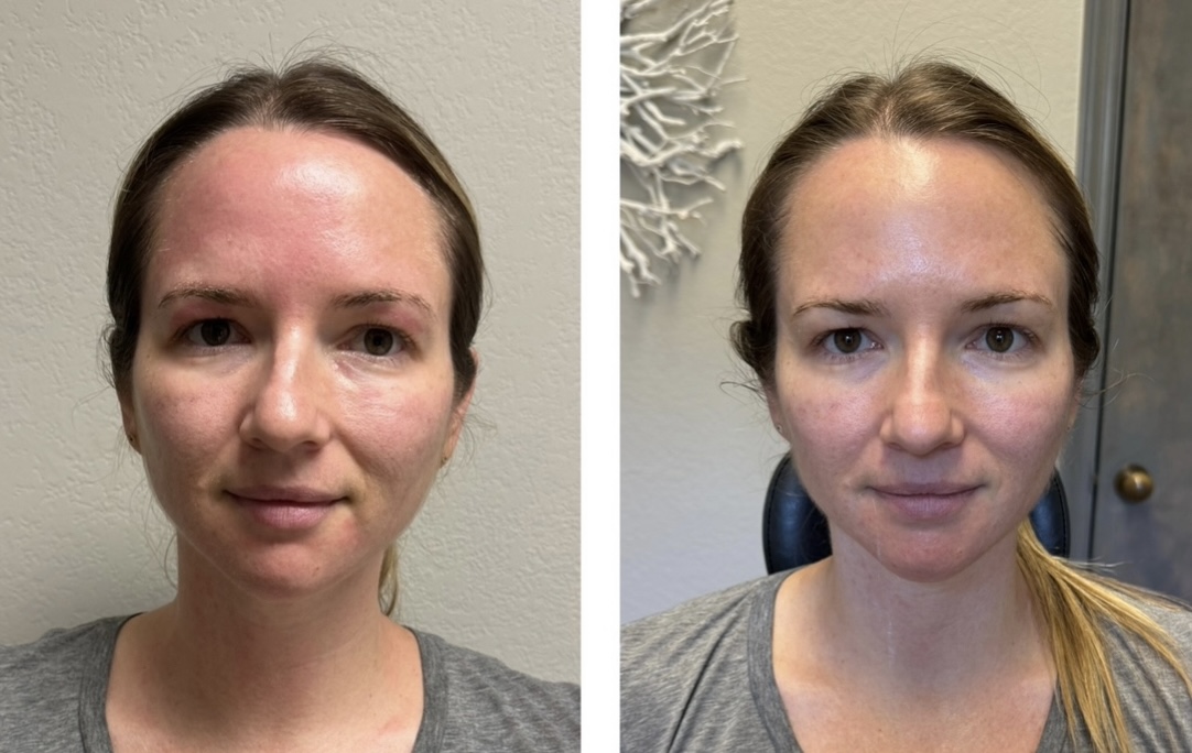 sofwave before and after results13