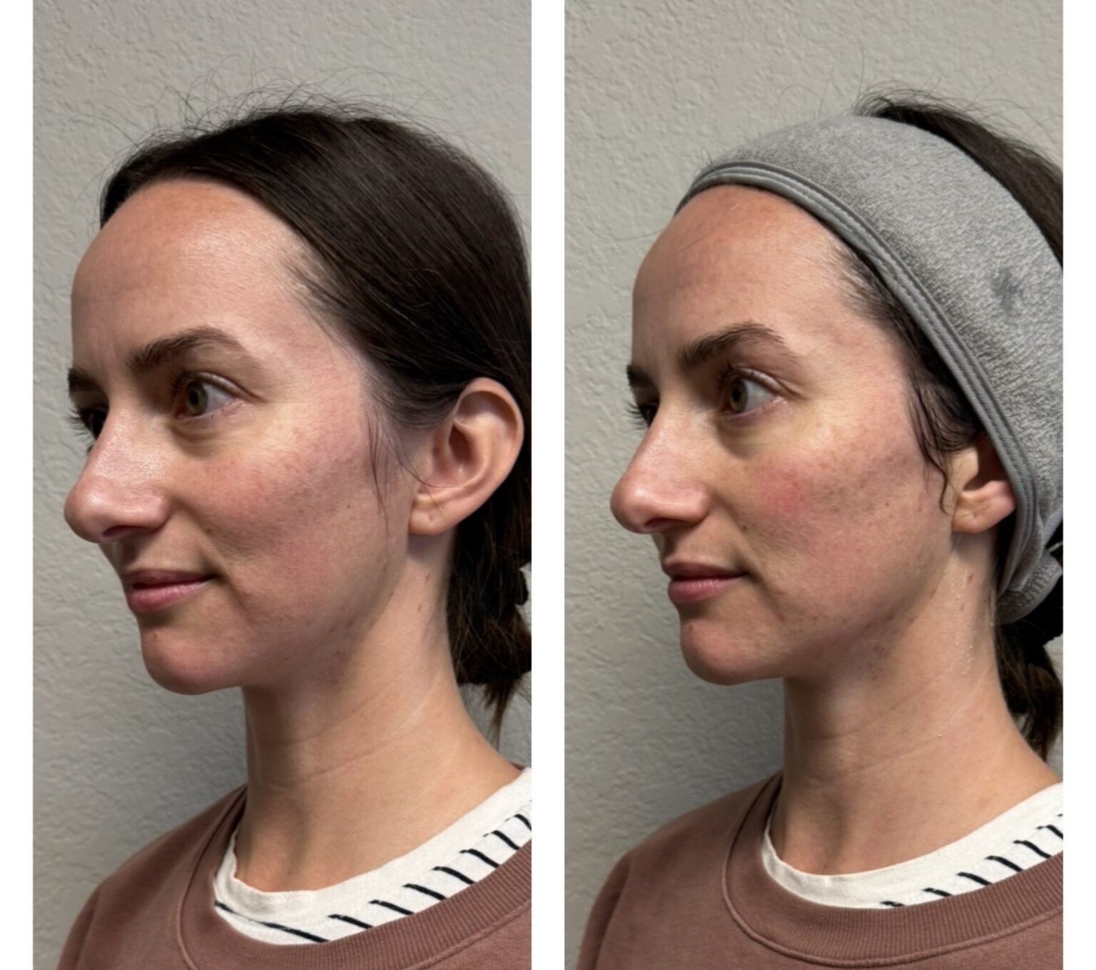 sofwave before and after results14