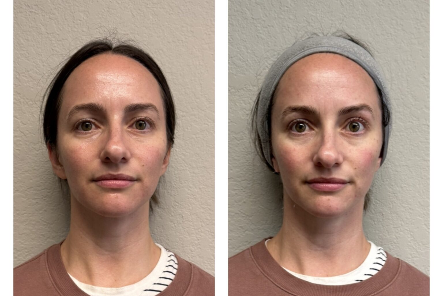 sofwave before and after results15