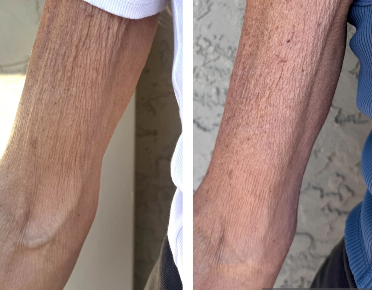 sofwave before and after results16