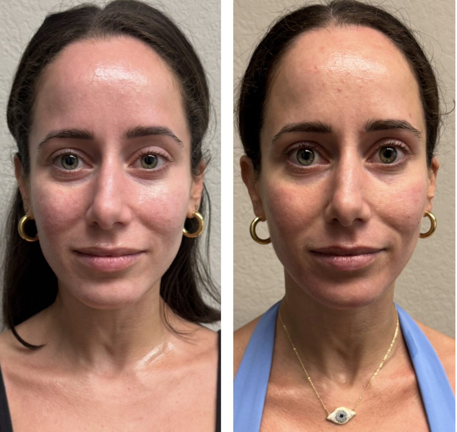 sofwave before and after results17