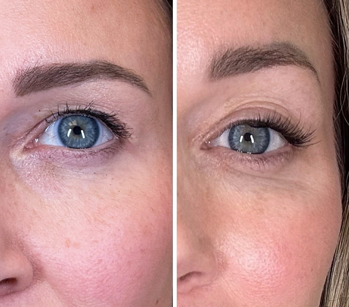 sofwave before and after results18