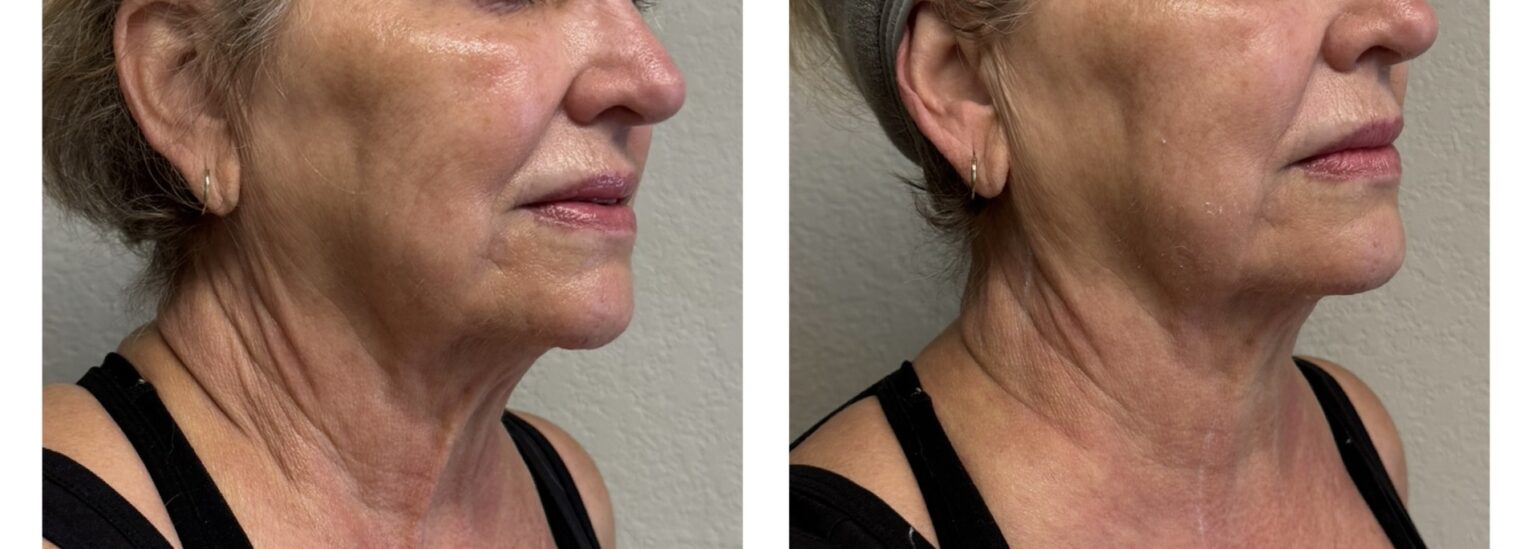 sofwave before and after results19