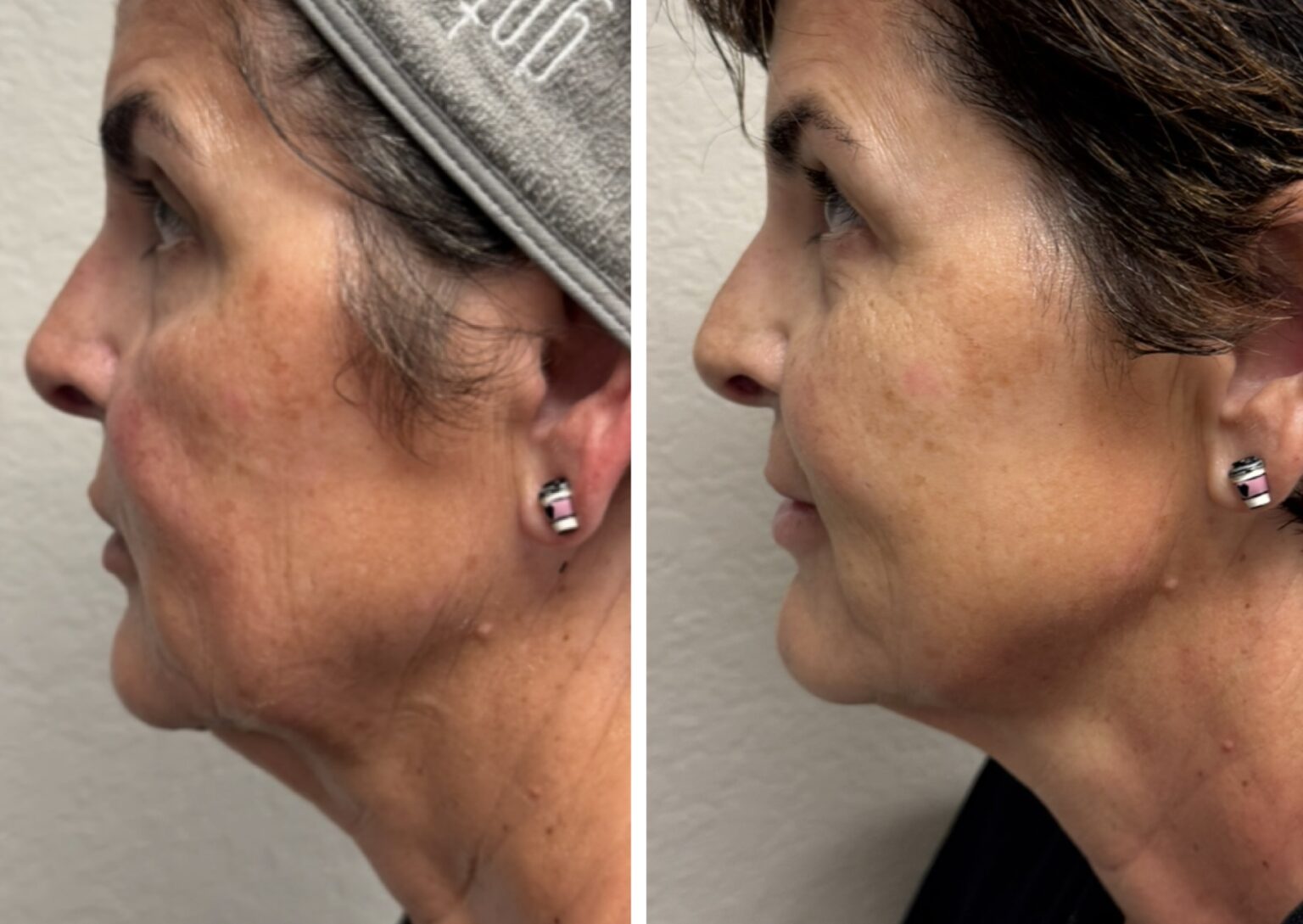 sofwave before and after results2