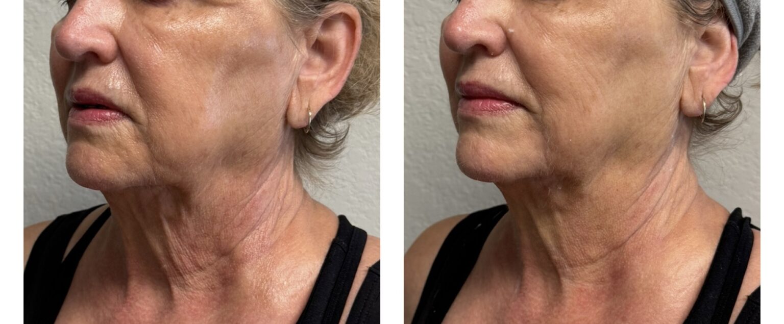 sofwave before and after results20