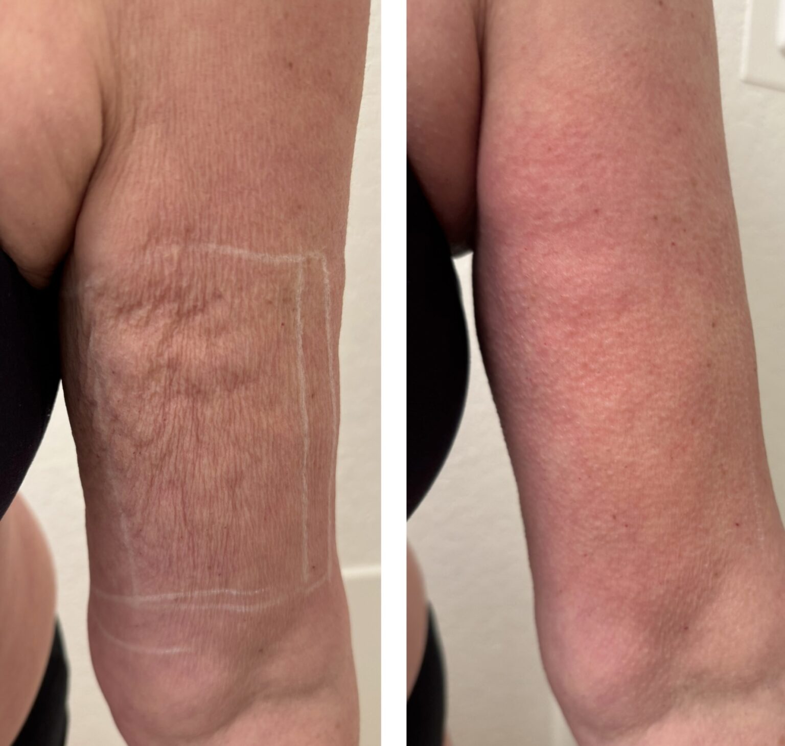 sofwave before and after results21