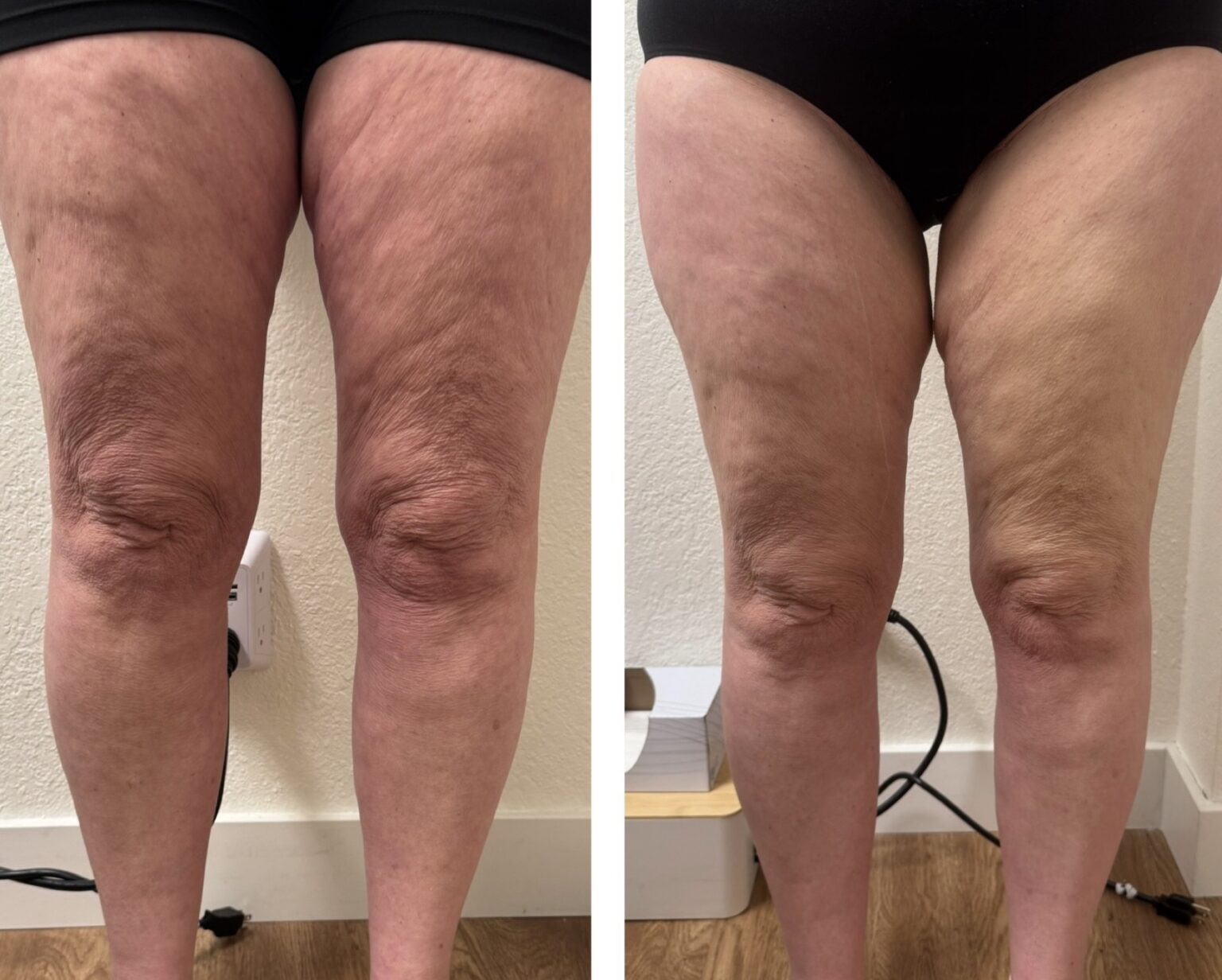 sofwave before and after results22