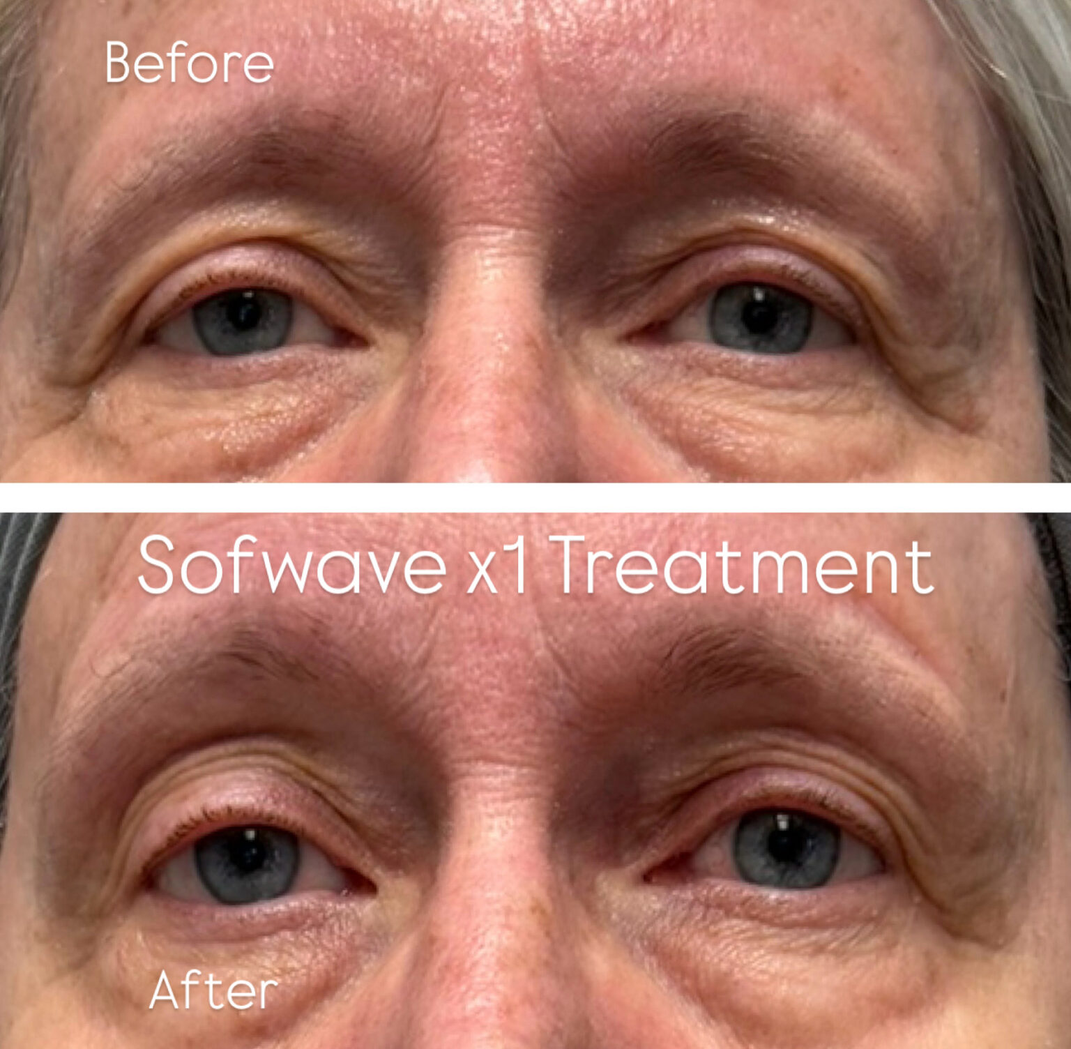 sofwave before and after results23