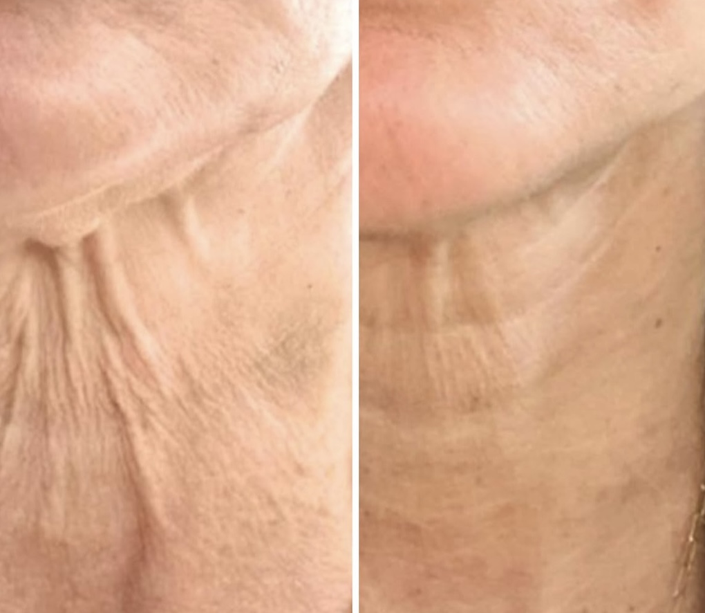 sofwave before and after results24