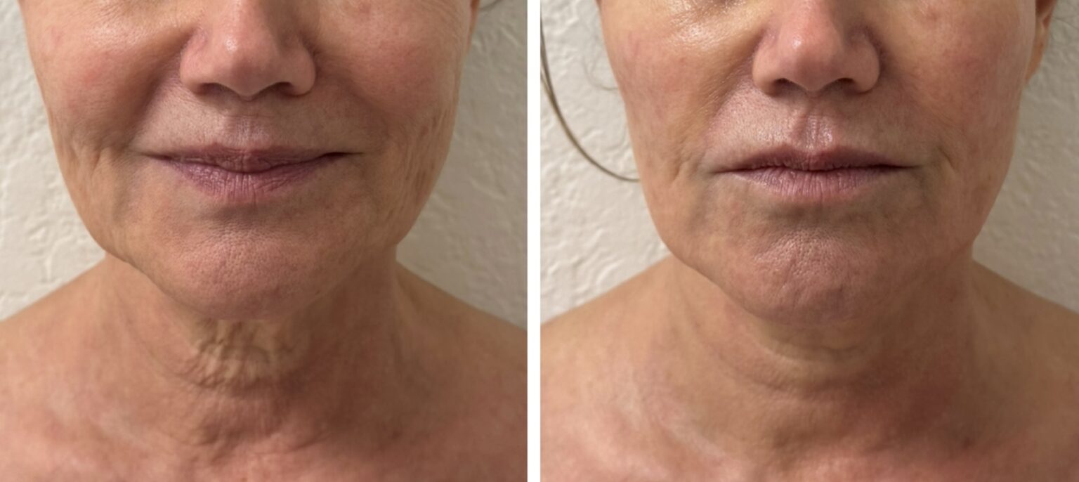 sofwave before and after results3