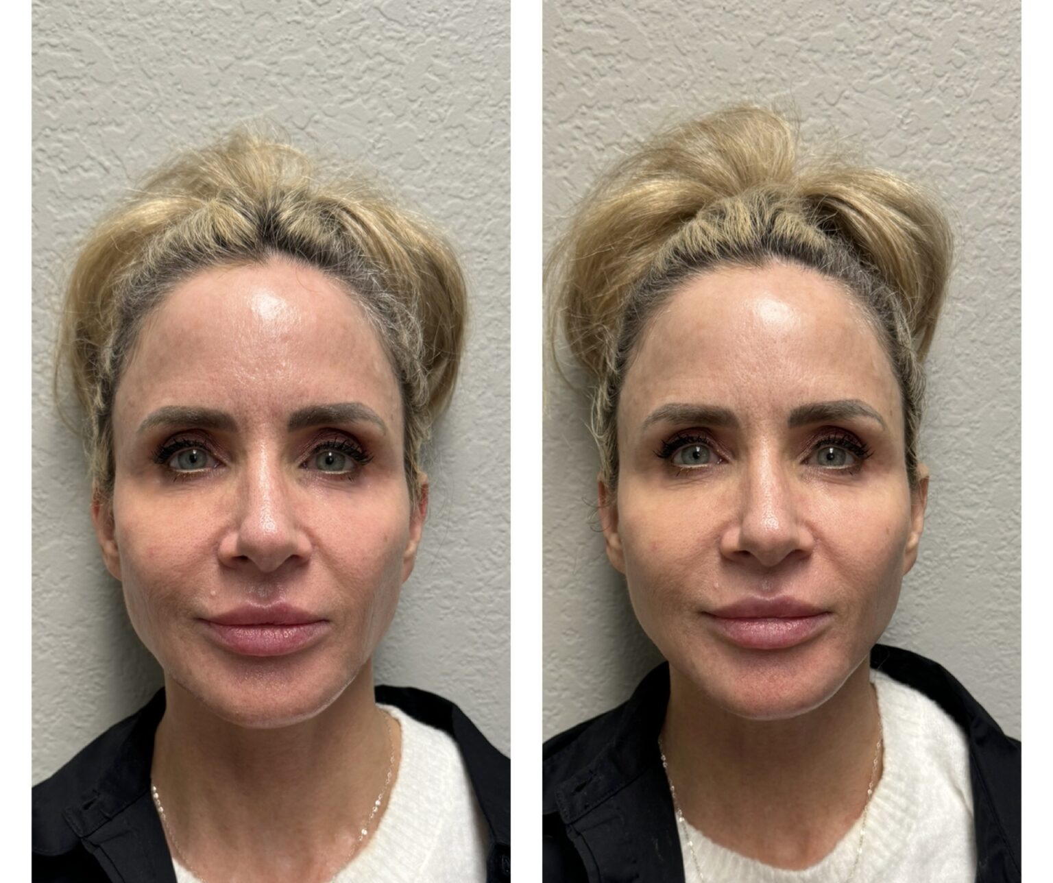 sofwave before and after results4