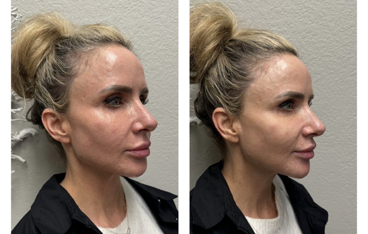 sofwave before and after results5