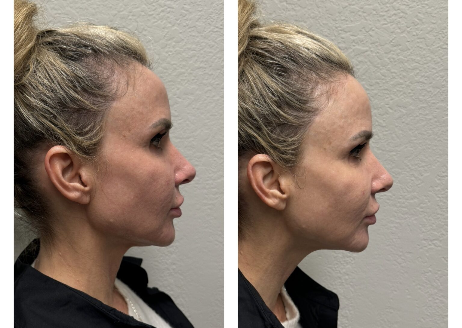 sofwave before and after results6