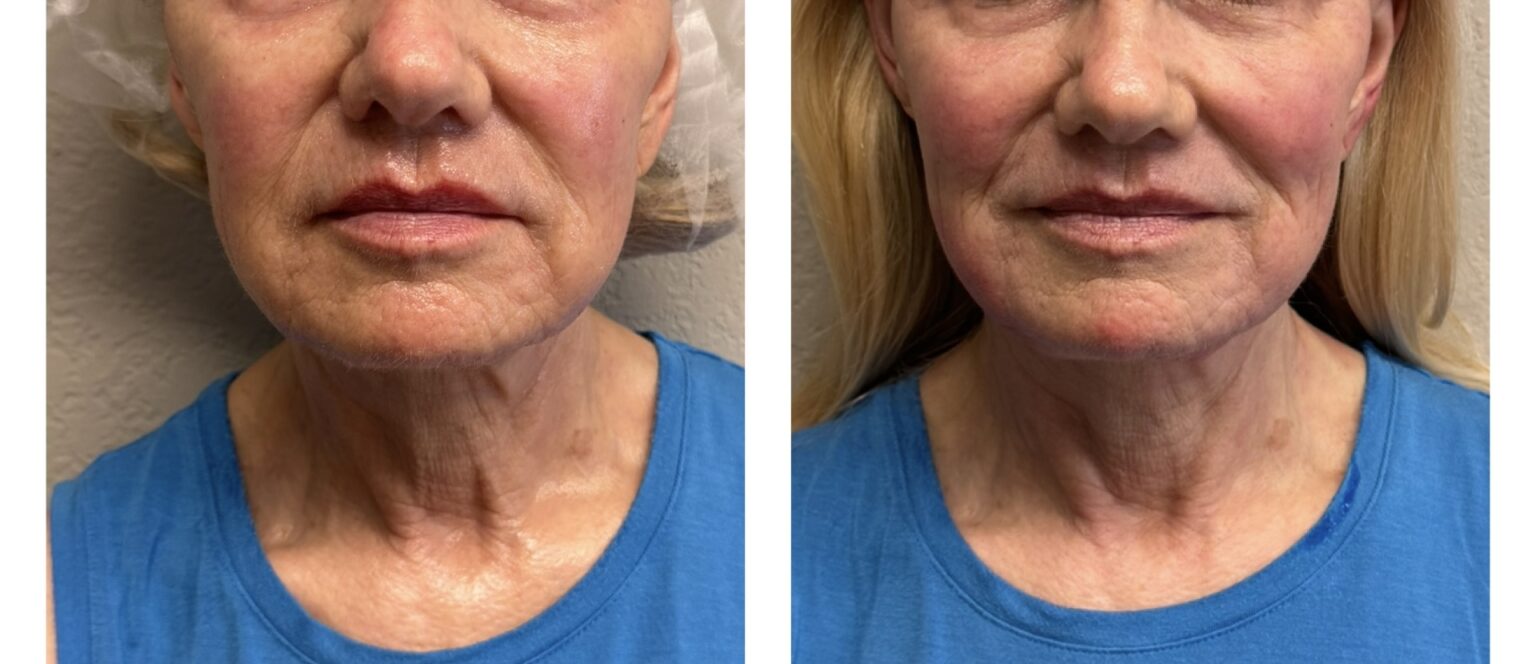 sofwave before and after results7