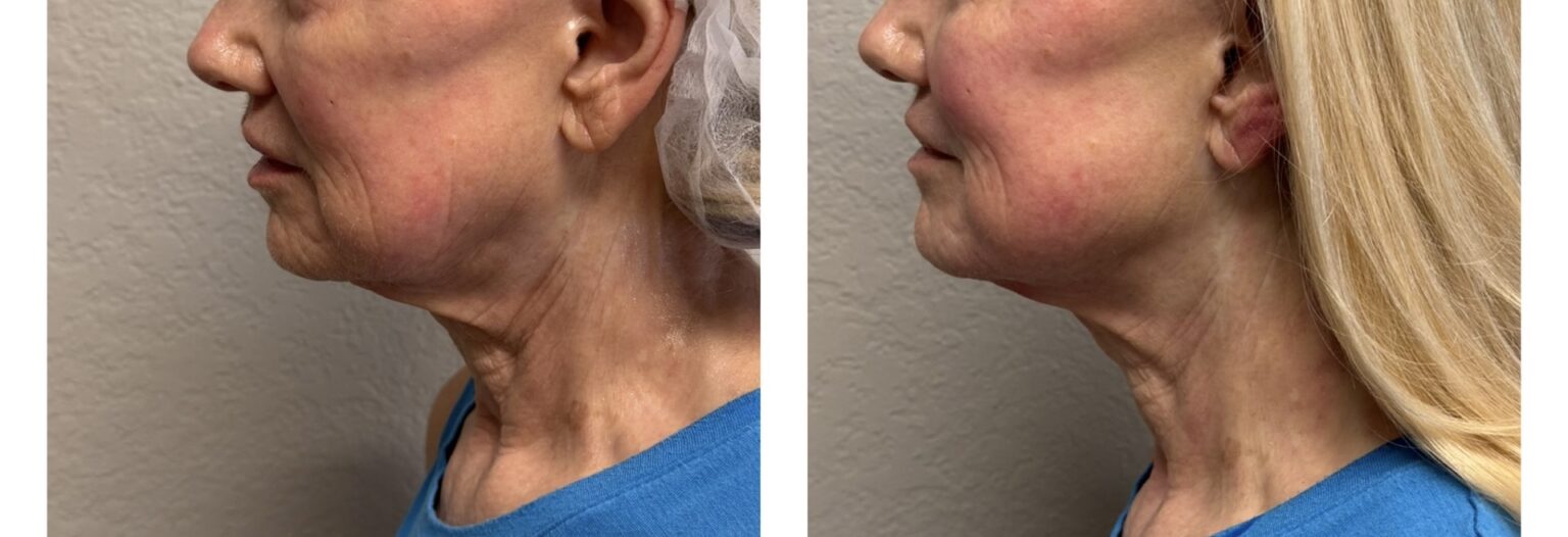 sofwave before and after results8