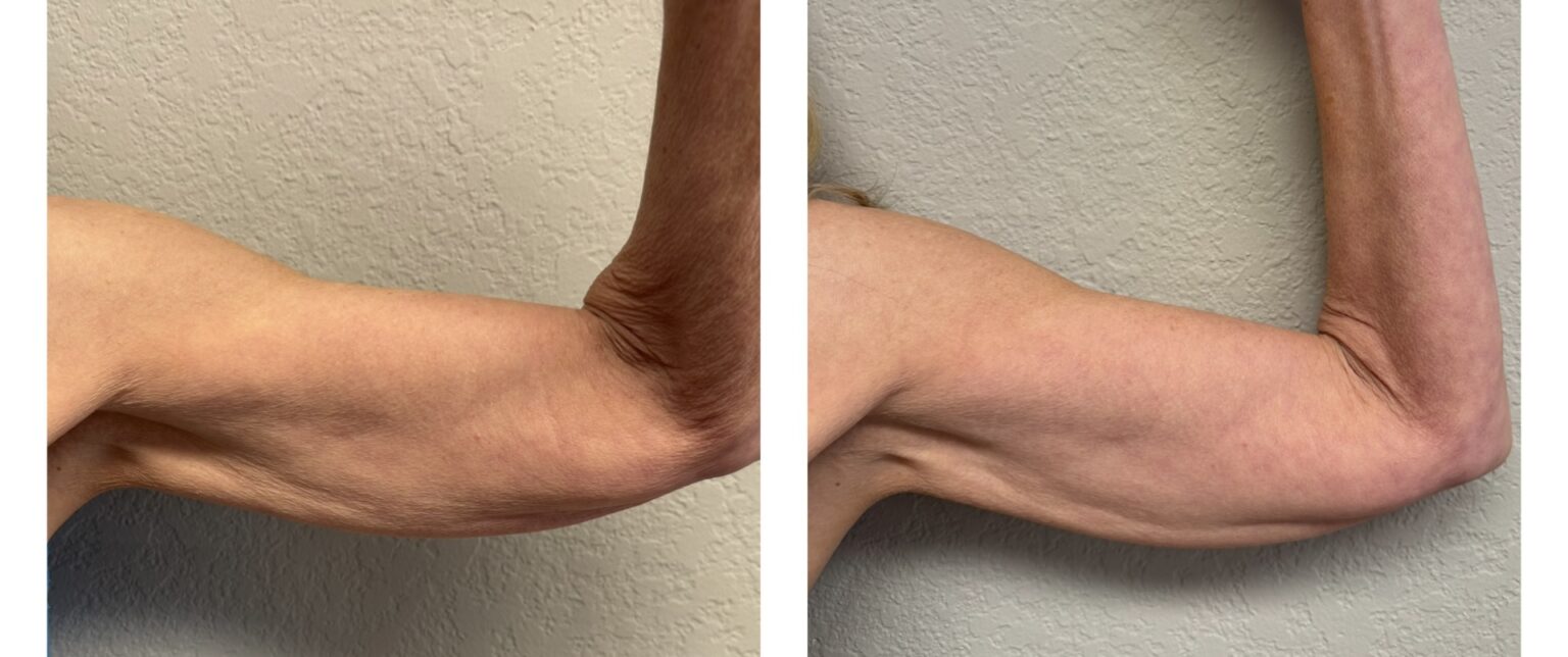 sofwave before and after results9