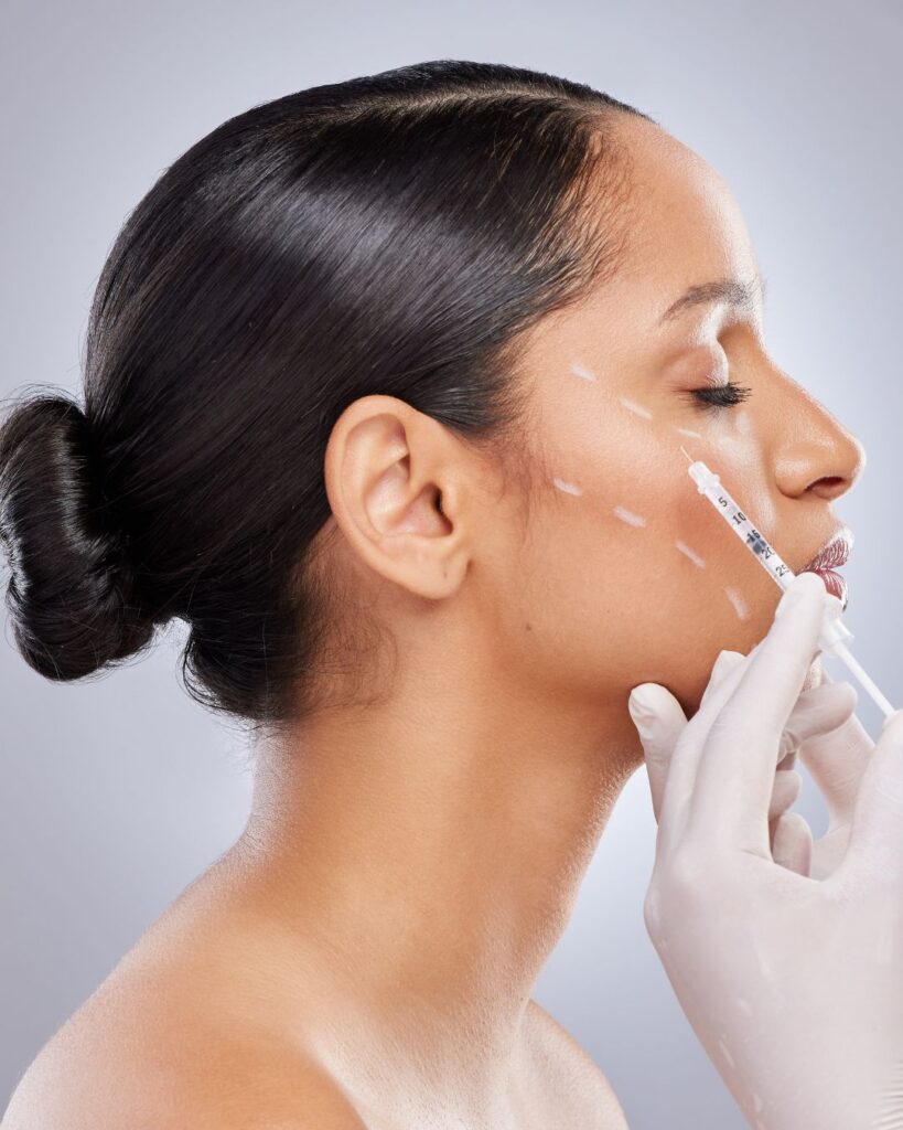 dermal fillers near san diego (1)
