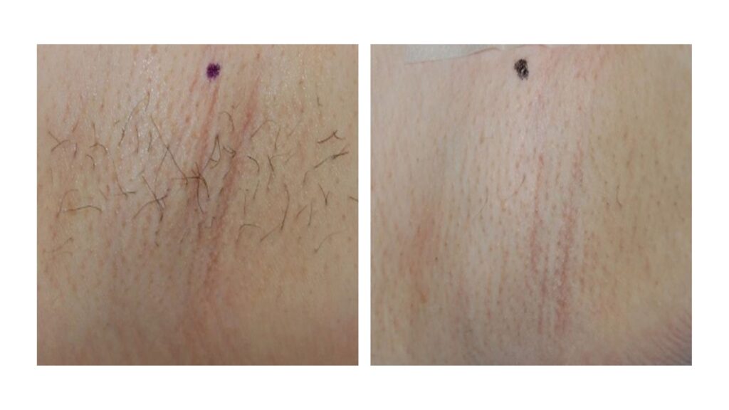 laser hair removal san diego med spa1