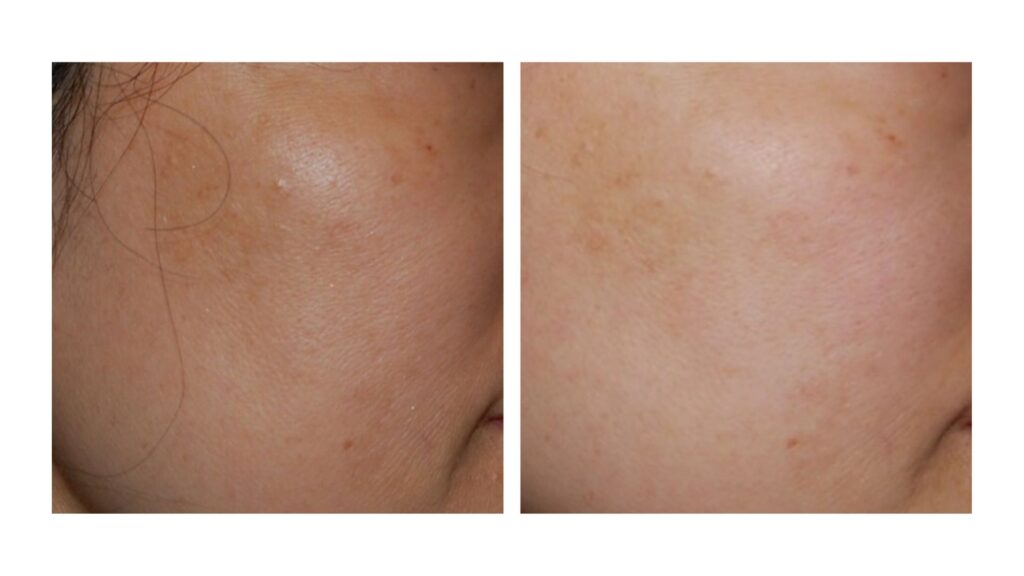 clarity 2 laser before and after results