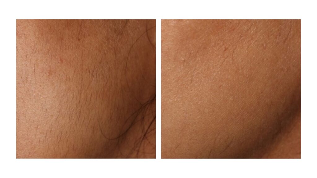 laser hair removal san diego med spa3