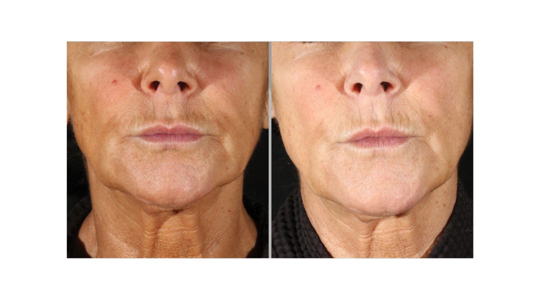 Xerf before and after results