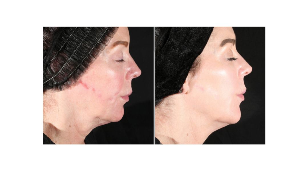 Xerf results on face, chin and neck